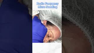 Radio Frequency Micro Needling Face [upl. by Uhile]