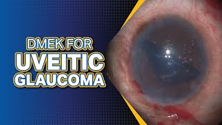 DMEK for Uveitic Glaucoma [upl. by Randee642]