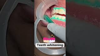 Step By Step Teeth Whitening Process  Happy Smiles Dental Care  DCH [upl. by Swigart522]