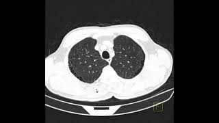 Enfisema pulmonar paraseptal [upl. by Sulecram]