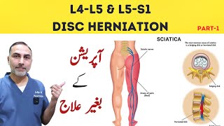 L4  L5 and L5 S1 Disc Herniation Treatment  Slip Disc Treatment At Home sciatica [upl. by Egwin756]