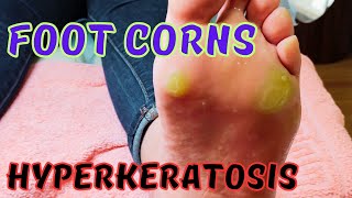 Satisfying foot corns removal Hyperkeratosis [upl. by Sualokin]