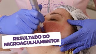 Resultados do Microagulhamento  Antes e Depois  Tratamento para Cicatriz de Acne [upl. by Idnib]