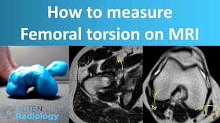 How to Measure Femoral Torsion on MRI [upl. by Sakmar]