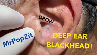 DPOW with firm blackhead lodged deep in ear Keratin pocket expressed just behind ear pearlMust see [upl. by Rimaa283]