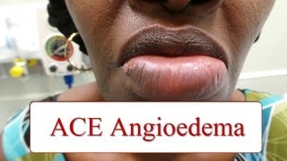 ACE Inhibitor Associated Angioedema [upl. by Persas]