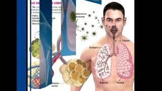 Neumonía Pulmonar [upl. by Siurtemed]