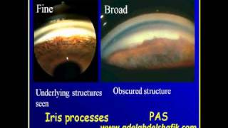 Gonioscopy Lecture part 4 [upl. by Aciras]