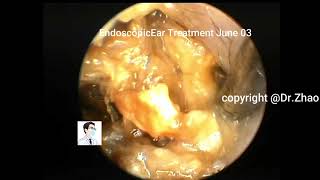 A complex cholesteatoma of the external auditory canal treated multiple days 11 min [upl. by Suoirrad661]