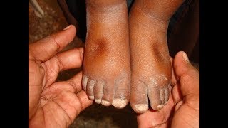 EDEMA Disease  Symptoms  Treatment  Causes 2018 [upl. by Nileuqaj441]