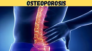 What is Osteoporosis 3d animation  pathophysiology symptoms causes  estrogen  old age  kya hindi [upl. by Derte]