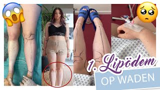 Meine 1 LIPÖDEM OPERATION  WADEN  Liposuktion Ergebnis Heilung Kosten etc  YooNessa [upl. by Eanel]