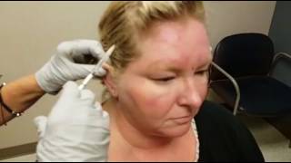 Botox for Migraines at Mercy [upl. by Sibbie]