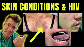 Doctor explains skin conditions associated with HIV  AIDS eg Kaposi sarcoma candida amp more [upl. by Nodnarg]