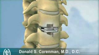 ProDiscC  Cervical Artificial Disc Replacement  ACDF Fusion  Orthopedic Spine Surgeon in Vail [upl. by Vallery]