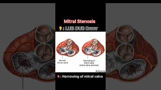 Heart sounds🫀 Heartsounds doctor heart sounds medicalstudy neet medicalstudent chestpain 🫀 [upl. by Stock]