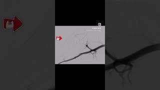 PAINFUL GROWING SWELLING ARTERIOVENOUS MALFORMATION TREATMENT BY embolization PINHOLE PROCEDURE [upl. by Bjork]