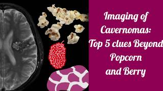 Imaging of cavernomas  Beyond Popcorn and Berry [upl. by Randee]