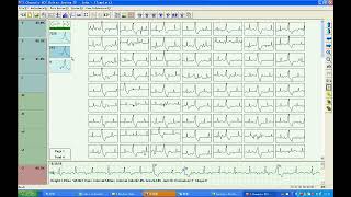 TLC9803 3 leads 3 Channels ECG Holter Operation English [upl. by Nikolos]