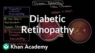 Diabetic retinopathy  Endocrine system diseases  NCLEXRN  Khan Academy [upl. by Adnavoj]