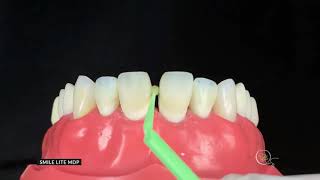 How to build proximal walls during diastema closure [upl. by Artimed]