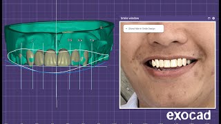 Exocad Mockup and Waxup Model creator [upl. by Ahsyia6]