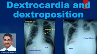 Dextrocardia and Dextroposition [upl. by Eninahpets]