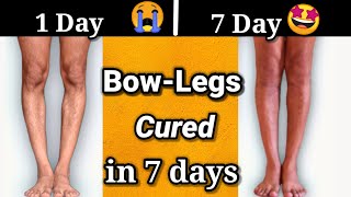 Bow leg problem solution with EXERCISES in 7 days [upl. by Freiman]