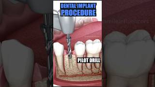 DENTAL IMPLANT 🦷 dentist trending dentisty viralvideo [upl. by Collins]