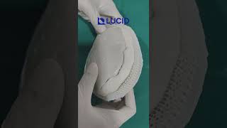 PMMA Bone Cement Implants  Custommade 3D printed moldbased Cranioplasty [upl. by Auqcinahs95]