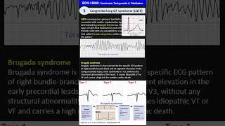 ECG  EKG 5 Ventricular Tachycardia Ventricular Fibrillation Ventricular Flutter Torsades de [upl. by Wyatt]