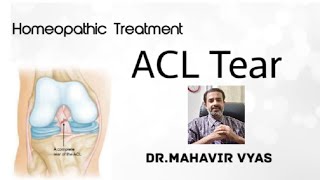 ACL Tear  Homeopathic Treatment  DrMahavir Vyas [upl. by Raphael]