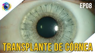 Transplante de córnea para o ceratocone EP 08  CHECKUP DOS OLHOS [upl. by Boyer]