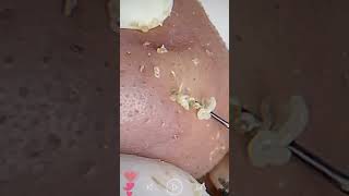 Skincare  Blackheads Removal 099 skincare skincare blackheads blackheads [upl. by Elleoj]