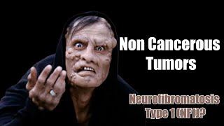 Noncancerous Tumors  What You Need to Know About Neurofibromatosis Type 1 NF1 [upl. by Korie]