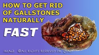 How to get rid of gallstones naturally [upl. by Allenrad]