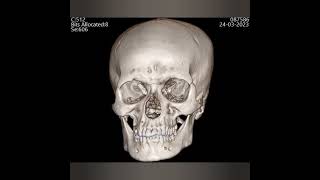 Normal NCCT 3D SKULL radiology [upl. by Hallee]