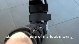 Stress Fracture 2nd Metatarsal [upl. by Nodnas964]