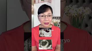 Ano ang BLIGHTED OVUM Vlog 173 [upl. by Daryl739]