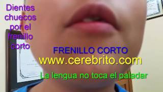 Frenillo Corto Anquiloglosia o Lengua Anclada [upl. by Reviel]