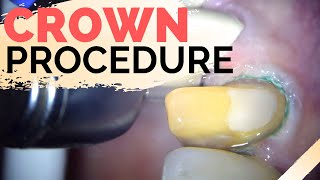 Dental Crown Explained  Anterior Crown Preparation [upl. by Kolva885]