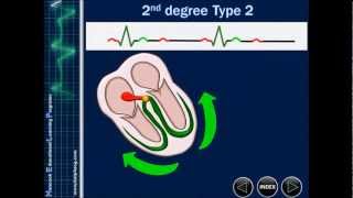 Heart block The best online ECG training available [upl. by Leamse]