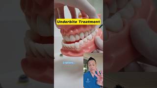 Transform Your Smile 3 Underbite Correction Options You Need to Know shorts dentallan [upl. by Thomson]