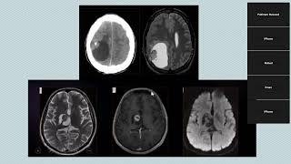 Neuroradiology meeting Pediatric brain tumors [upl. by Papageno]