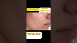 duac acne gel before and afterbest acne treatment by dermatologistacnetreatment trendingvideo [upl. by Halverson432]