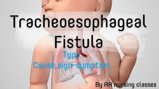 Tracheoesophageal Fistula TEF cause signsymptom childhealthnursing bscnursing 5thsem24 [upl. by Huberty]