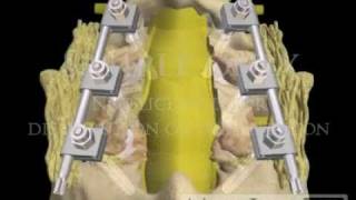 Lumbar Spine Pedicle Screw Fixation Fusion lawyer 3D animations [upl. by Ettenim]