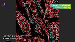 3Dimmunofluorescence of a human ovarian cancer stained with CD326 EpCAM Antibody [upl. by Ahsinaj]