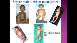 Management of severe malnutrition [upl. by Ivonne887]