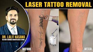 LASER TATTOO REMOVAL  BEFORE amp AFTER [upl. by Elvah]